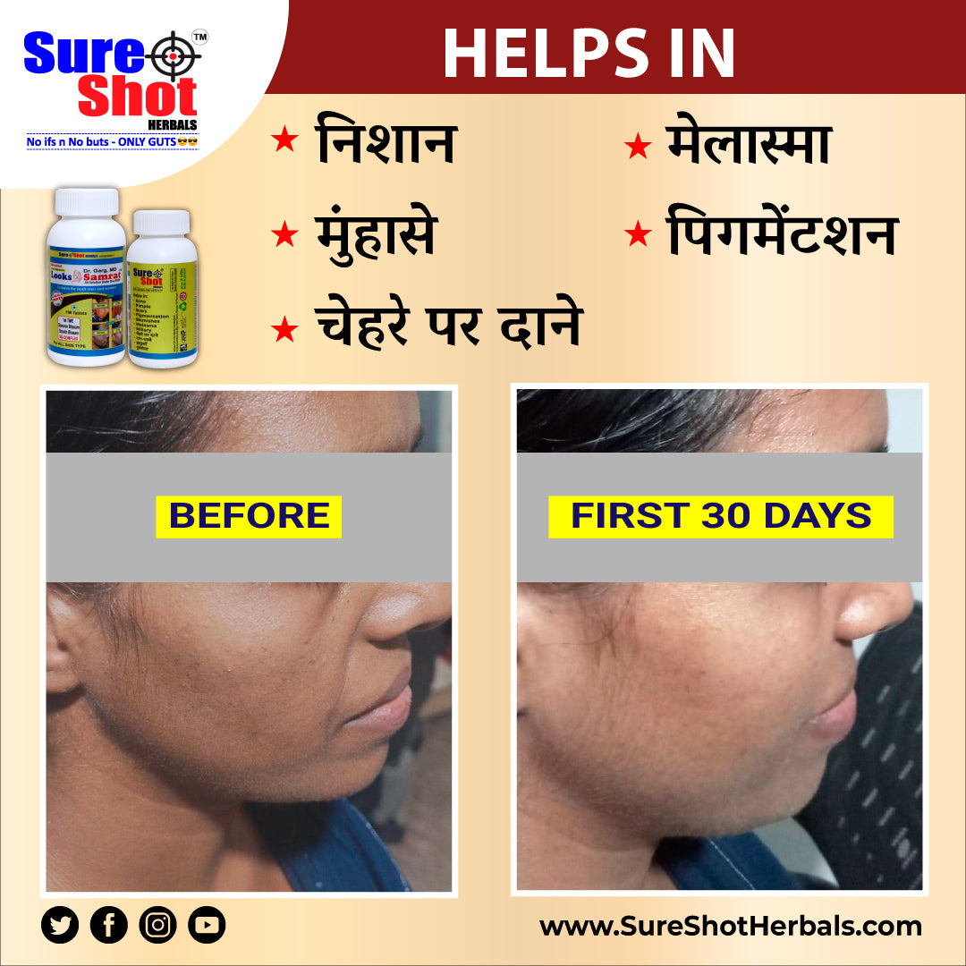Dr.Garg's M.D. - Looks Samrat Tablets (100 Pcs) For Acne And Pimple, Scar, Pigmentation, Blemishes, Melasma, Miliary