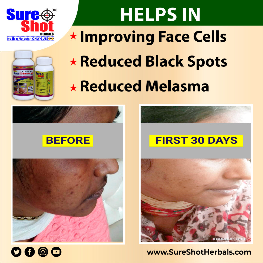 Dr.Garg's M.D. - Roop Samrat Tablets (100 Pcs) For All Skin Type, Reduced Appearance Of Black Spots,