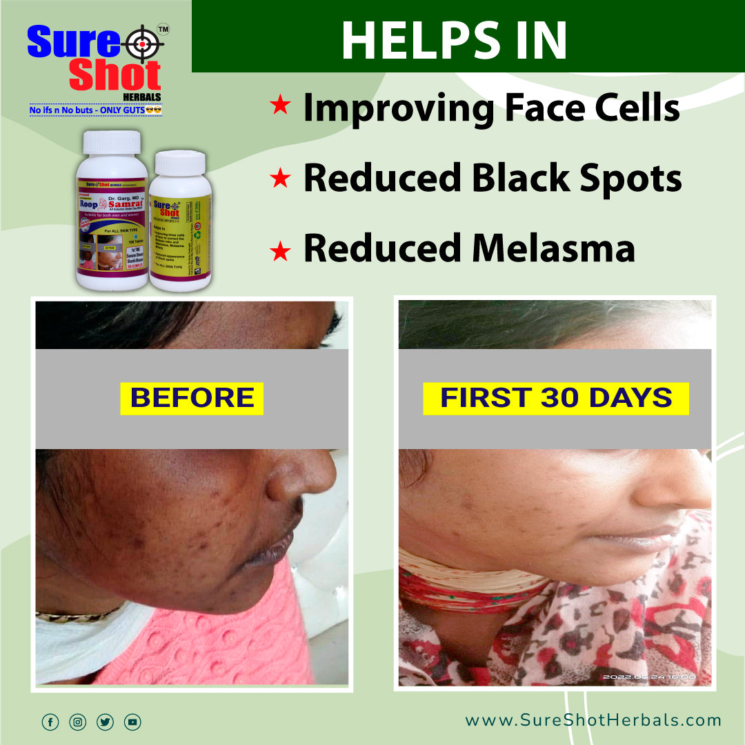 Dr.Garg's M.D. - Roop Samrat Tablets (100 Pcs) For All Skin Type, Reduced Appearance Of Black Spots,