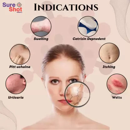 Dr.Garg's M.D. - URTICARIA - Swelling - Hives - Itching - Burning - Irritation