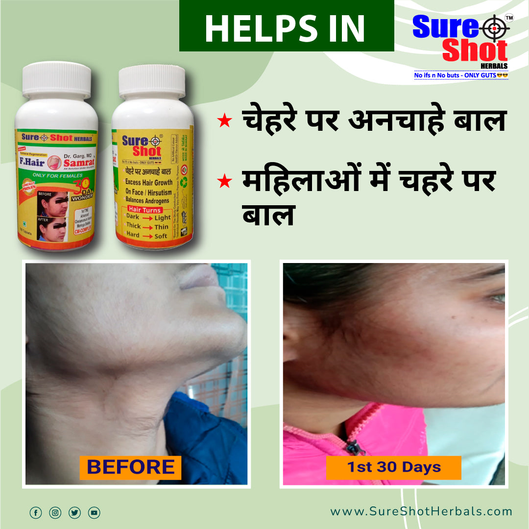 Dr.Garg's M.D.- Facial Hairs - Chin - Upper Lips - Hirsutism -