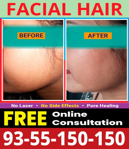Dr.Garg's M.D.- Facial Hairs - Chin - Upper Lips - Hirsutism -