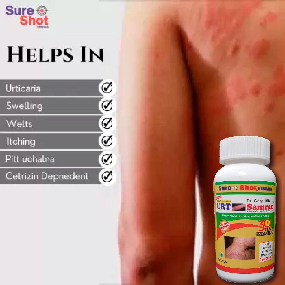 Dr.Garg's M.D. - URTICARIA - Swelling - Hives - Itching - Burning - Irritation