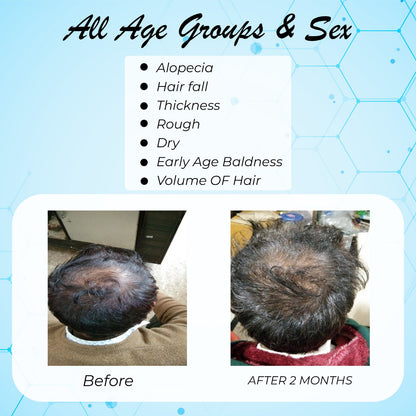 Dr.Garg's M.D. -Hair Samrat - HairFall - Dandruff - Growth Of Hairs Volume, Density, Long Hair, Rough Dry